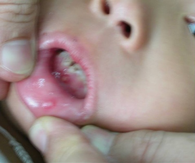 Nốt mụn nước trên da bé